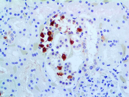IHC of Galectin-3 on a FFPE Follicular Carcinoma of Thyroid Tissue